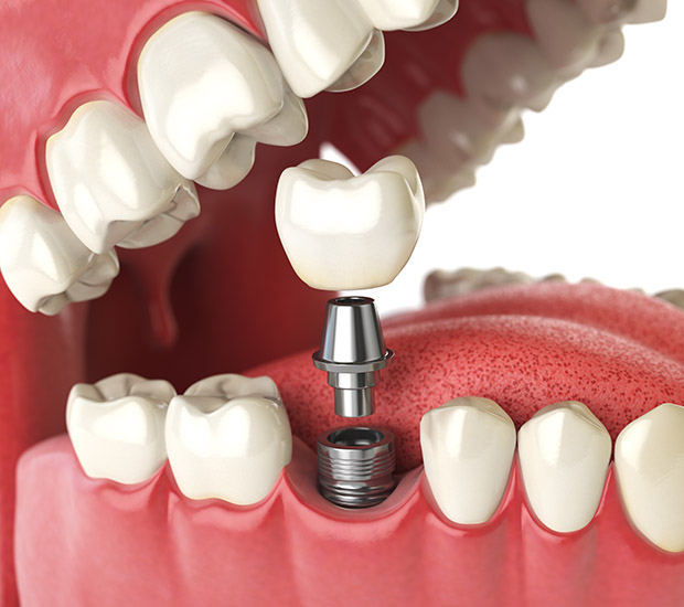 Johns Creek Will I Need a Bone Graft for Dental Implants