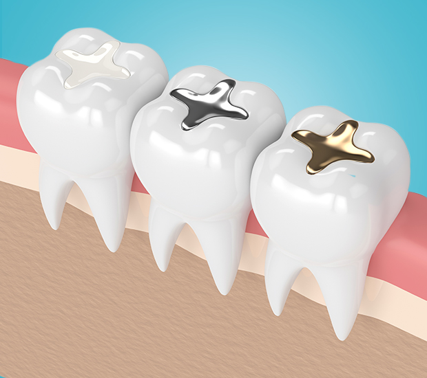 Johns Creek Composite Fillings