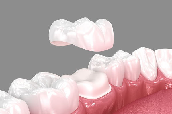 The Steps Of A Dental Crown Restoration