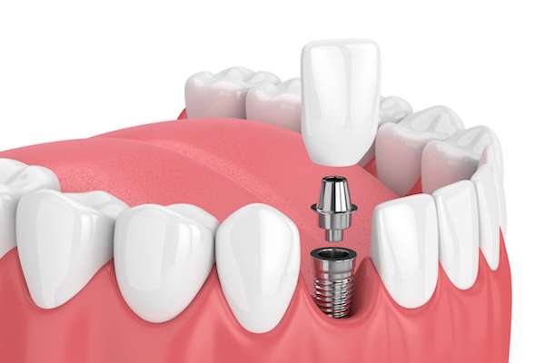 How Painful is Dental Implant Surgery from Johns Creek Dentistry in Johns Creek, GA