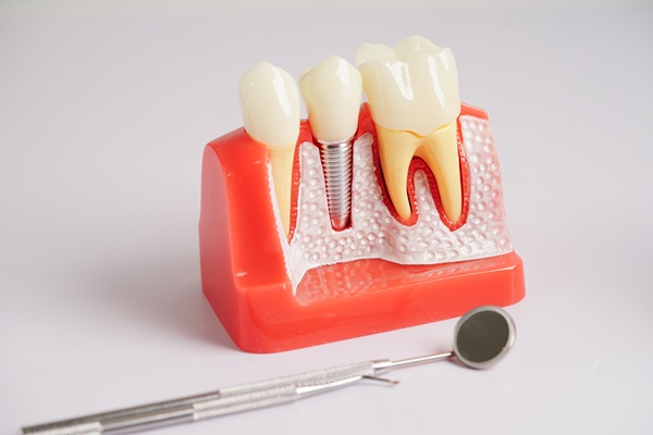 How Long Is The Process For Placing Implant Crowns?