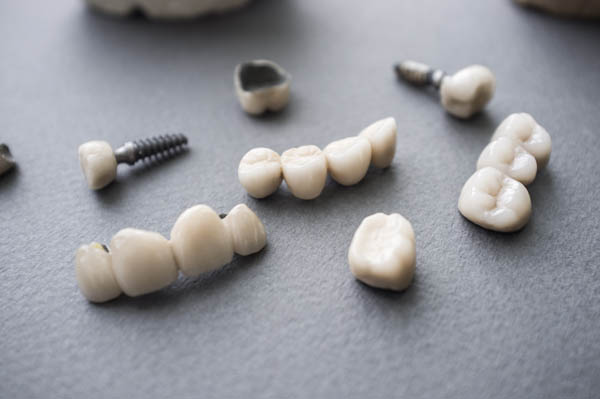 Signs You Might Require An Implant Restoration