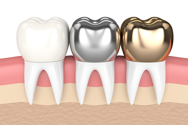 Metal Crowns vs. Porcelain Dental Crowns from Johns Creek Dentistry in Johns Creek, GA