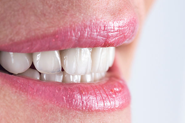 How To Prevent Cavities Under Veneers from Johns Creek Dentistry in Johns Creek, GA